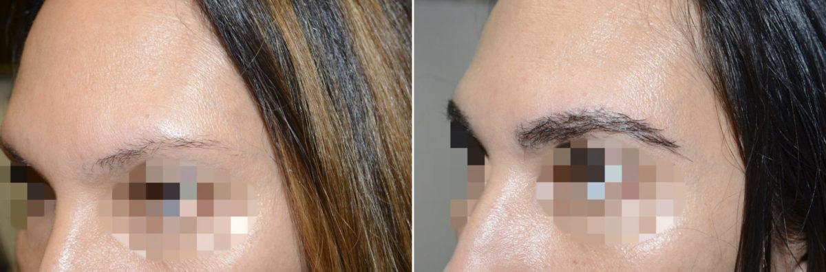 Eyebrow Transplantation before and after photos in Miami, FL, Patient 15923