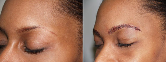 Eyebrow Transplantation before and after photos in Miami, FL, Patient 15930