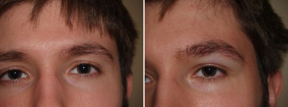 Eyebrow Transplantation before and after photos in Miami, FL, Patient 15942