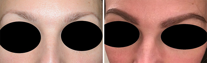Eyebrow Transplantation before and after photos in Miami, FL, Patient 15950