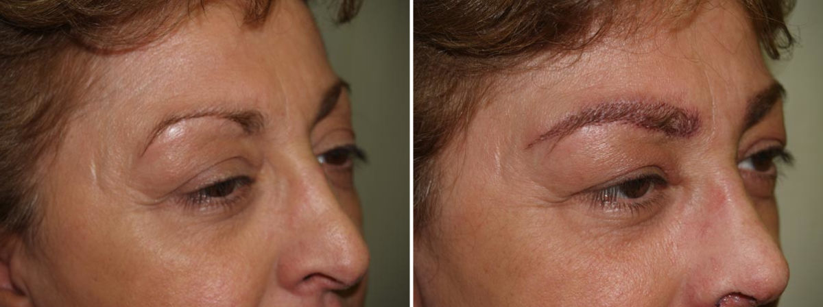 Eyebrow Transplantation before and after photos in Miami, FL, Patient 15982