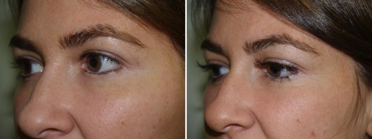 Eyebrow Transplantation before and after photos in Miami, FL, Patient 15994