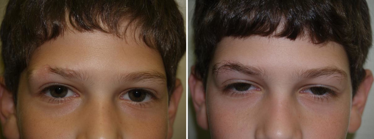 Eyebrow Transplantation before and after photos in Miami, FL, Patient 15999