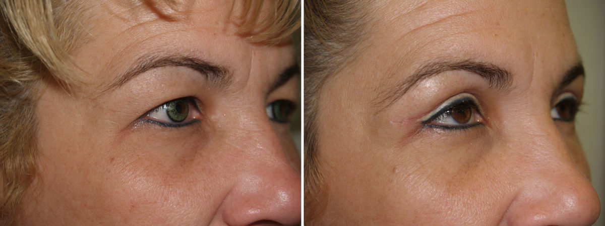 Eyebrow Transplantation before and after photos in Miami, FL, Patient 16007