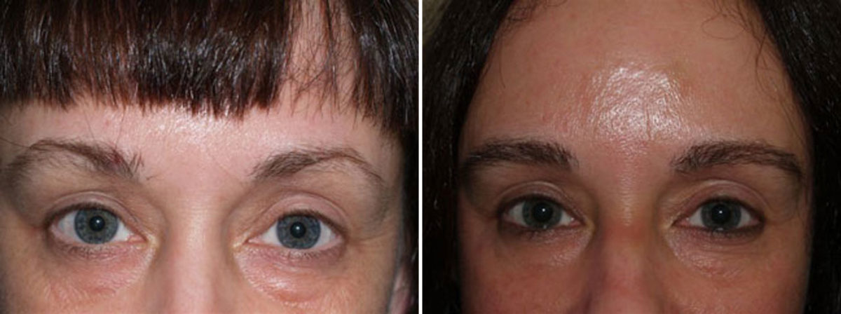 Eyebrow Transplantation before and after photos in Miami, FL, Patient 16018