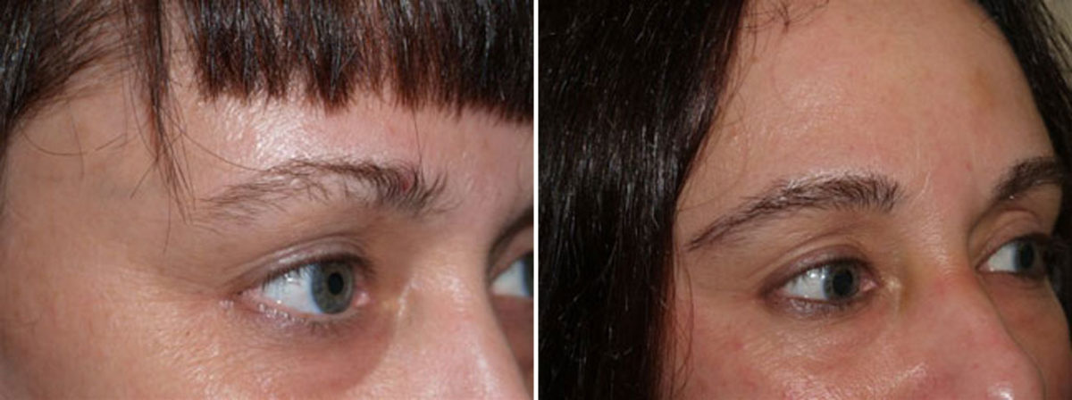 Eyebrow Transplantation before and after photos in Miami, FL, Patient 16018