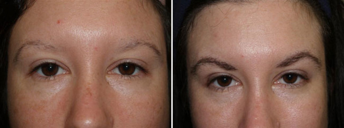 Eyebrow Transplantation before and after photos in Miami, FL, Patient 16023