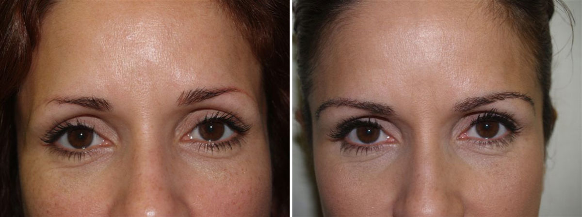 Eyebrow Transplantation before and after photos in Miami, FL, Patient 16034