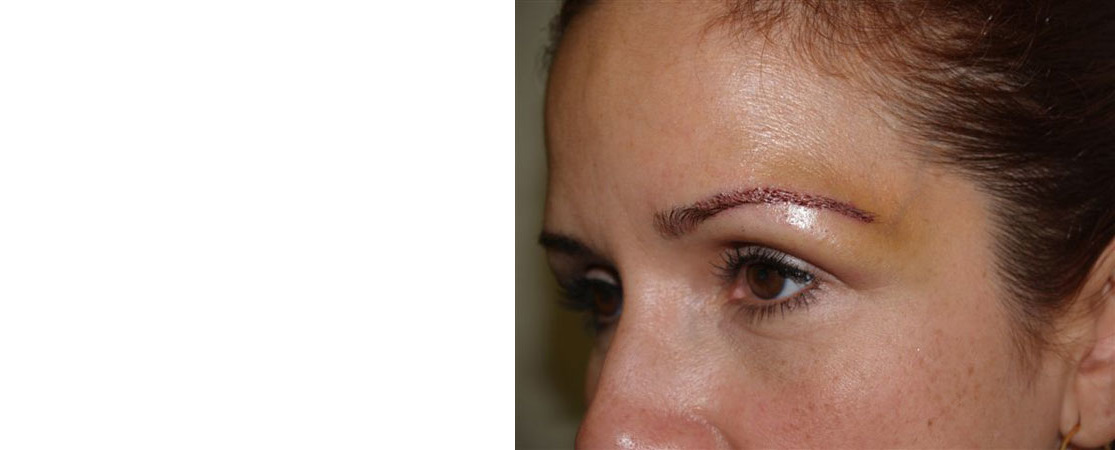 Eyebrow Transplantation before and after photos in Miami, FL, Patient 16034
