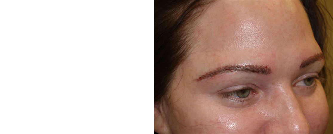 Eyebrow Transplantation before and after photos in Miami, FL, Patient 16041