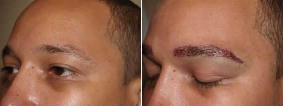 Eyebrow Transplantation before and after photos in Miami, FL, Patient 16050
