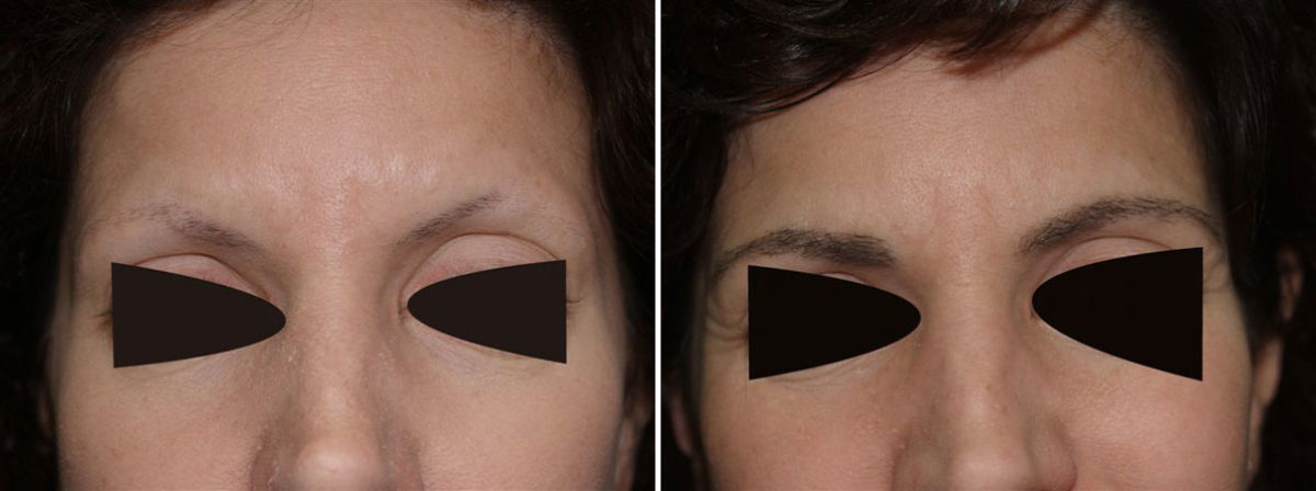 Eyebrow Transplantation before and after photos in Miami, FL, Patient 16055