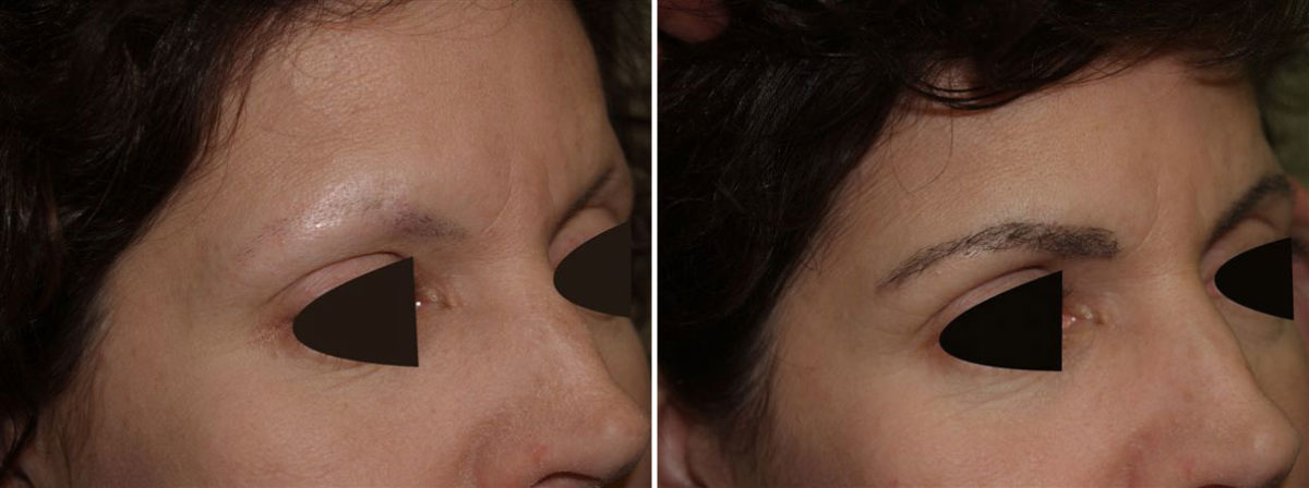 Eyebrow Transplantation before and after photos in Miami, FL, Patient 16055