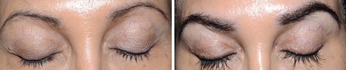 Eyebrow Transplantation before and after photos in Miami, FL, Patient 16060