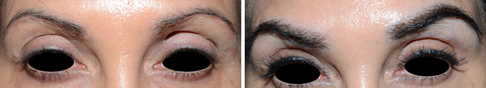 Eyebrow Transplantation before and after photos in Miami, FL, Patient 16060