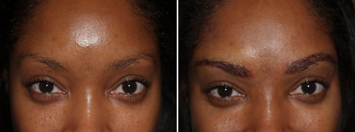 Eyebrow Transplantation before and after photos in Miami, FL, Patient 16067