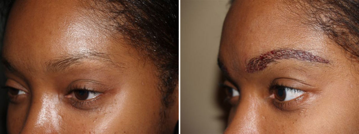 Eyebrow Transplantation before and after photos in Miami, FL, Patient 16067