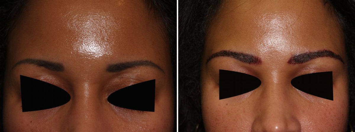 Eyebrow Transplantation before and after photos in Miami, FL, Patient 16081