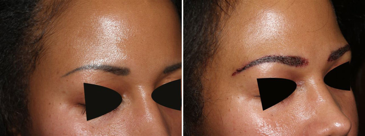 Eyebrow Transplantation before and after photos in Miami, FL, Patient 16081