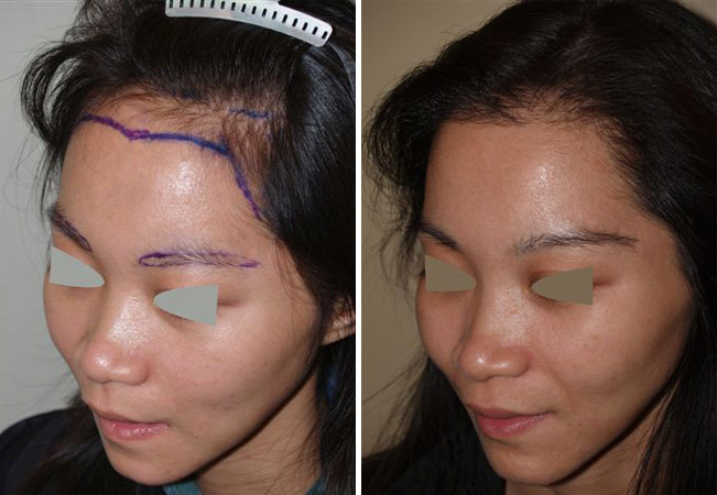 Eyebrow Transplantation before and after photos in Miami, FL, Patient 16086
