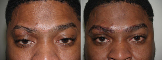 Eyebrow Transplantation before and after photos in Miami, FL, Patient 16113