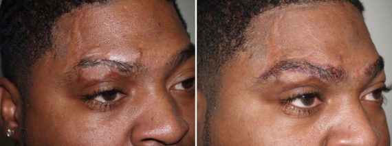Eyebrow Transplantation before and after photos in Miami, FL, Patient 16113