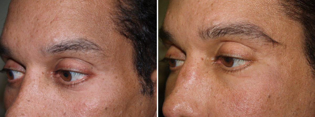 Eyebrow Transplantation before and after photos in Miami, FL, Patient 16118