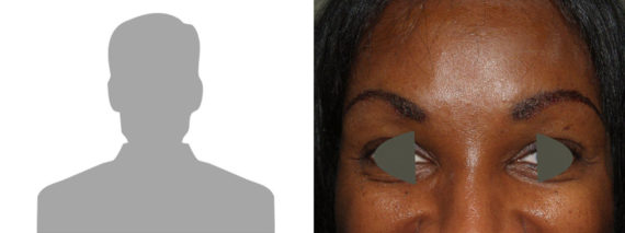 Eyebrow Transplantation before and after photos in Miami, FL, Patient 16130