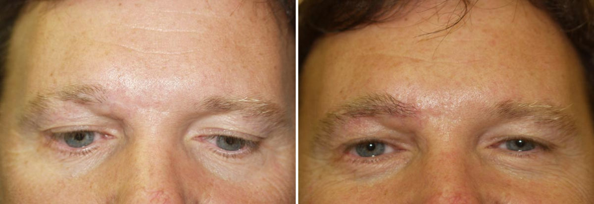 Eyebrow Transplantation before and after photos in Miami, FL, Patient 16150