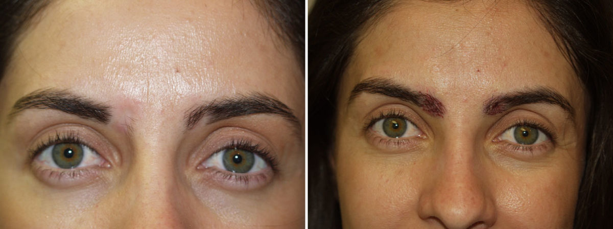 Eyebrow Transplantation before and after photos in Miami, FL, Patient 16160