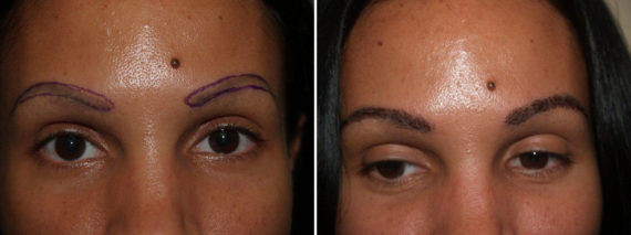 Eyebrow Transplantation before and after photos in Miami, FL, Patient 16174