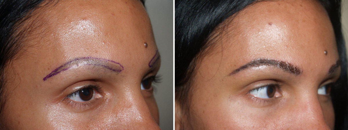 Eyebrow Transplantation before and after photos in Miami, FL, Patient 16174