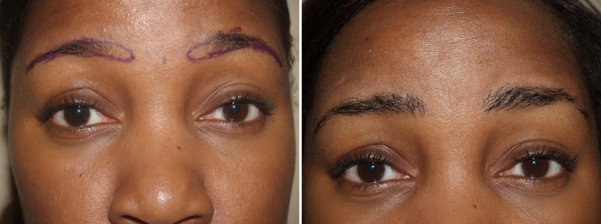 Eyebrow Transplantation before and after photos in Miami, FL, Patient 16220