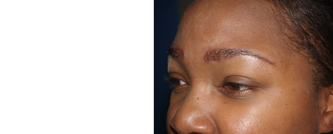 Eyebrow Transplantation before and after photos in Miami, FL, Patient 16220