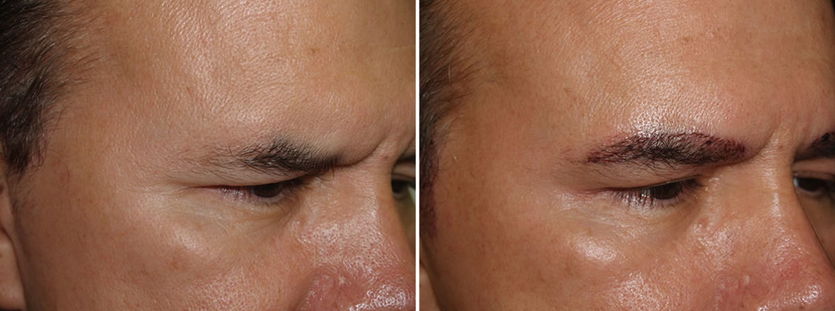 Eyebrow Transplantation before and after photos in Miami, FL, Patient 16258