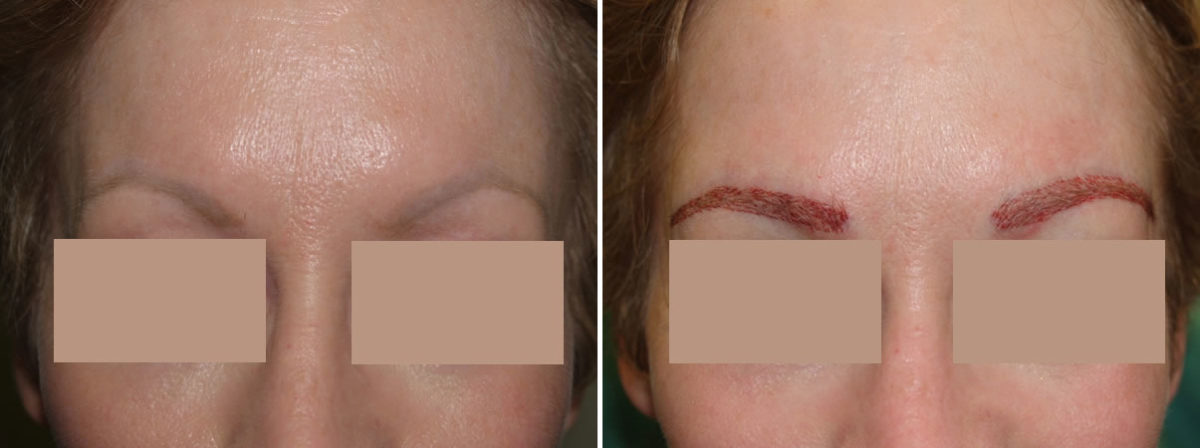 Eyebrow Transplantation before and after photos in Miami, FL, Patient 16261