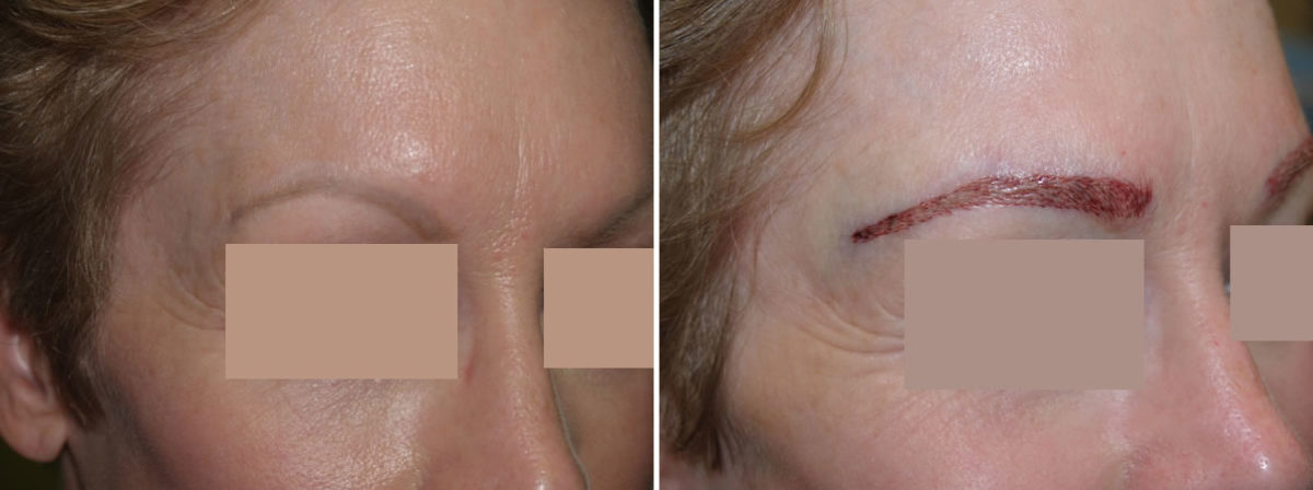 Eyebrow Transplantation before and after photos in Miami, FL, Patient 16261