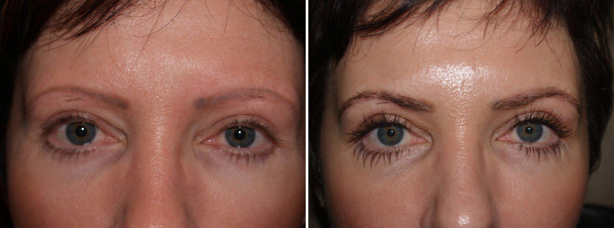 Eyebrow Transplantation before and after photos in Miami, FL, Patient 16287