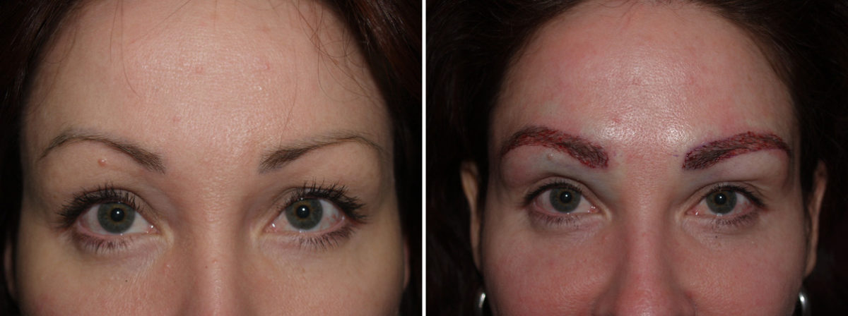 Eyebrow Transplantation before and after photos in Miami, FL, Patient 16307