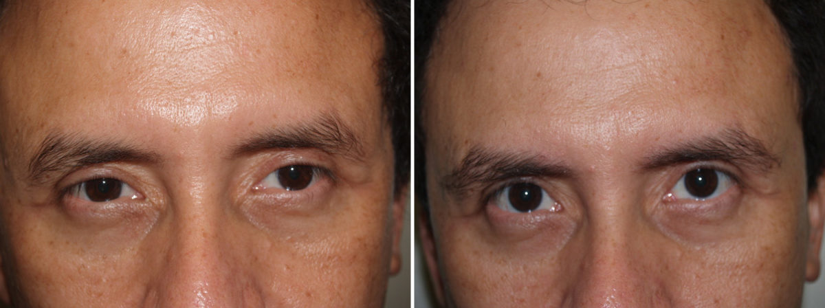 Eyebrow Transplantation before and after photos in Miami, FL, Patient 16314