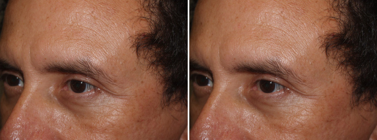 Eyebrow Transplantation before and after photos in Miami, FL, Patient 16314