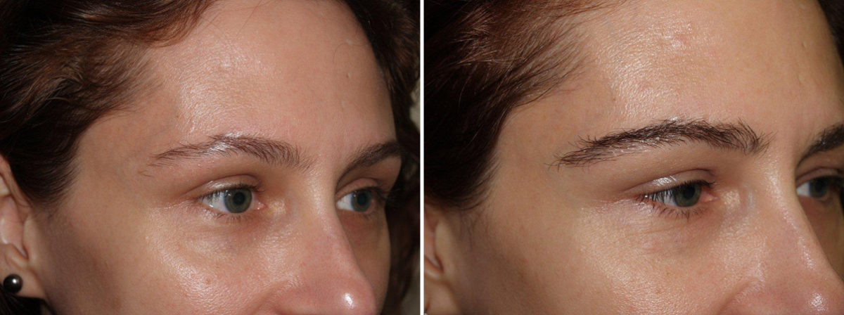 Eyebrow Transplantation before and after photos in Miami, FL, Patient 16330