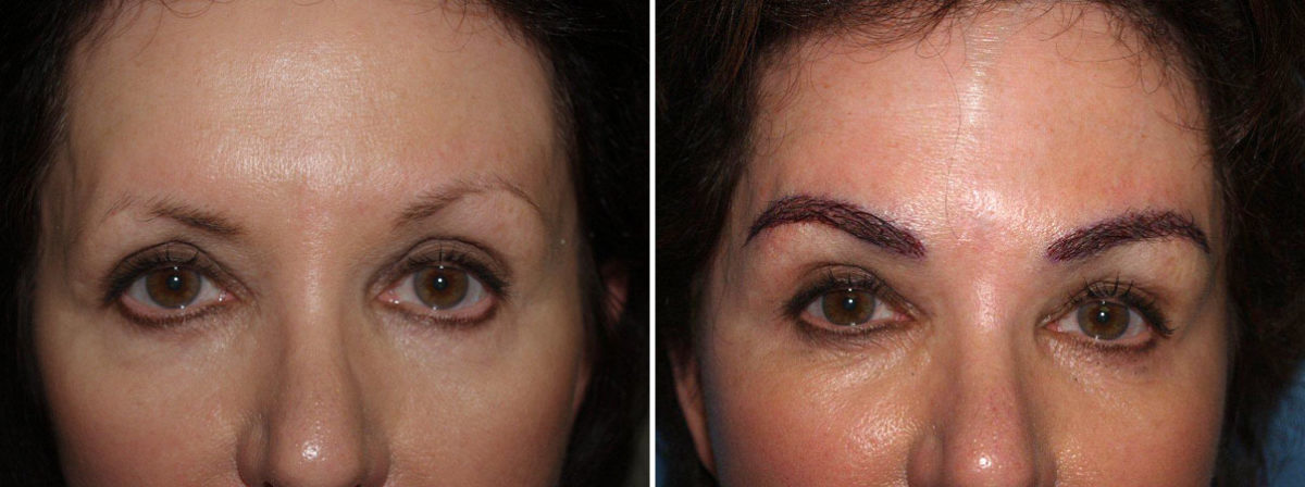 Eyebrow Transplantation before and after photos in Miami, FL, Patient 16349