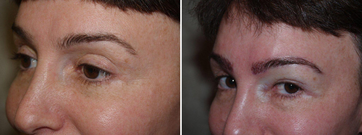 Eyebrow Transplantation before and after photos in Miami, FL, Patient 16356