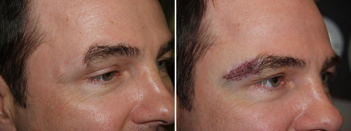 Eyebrow Transplantation before and after photos in Miami, FL, Patient 16363