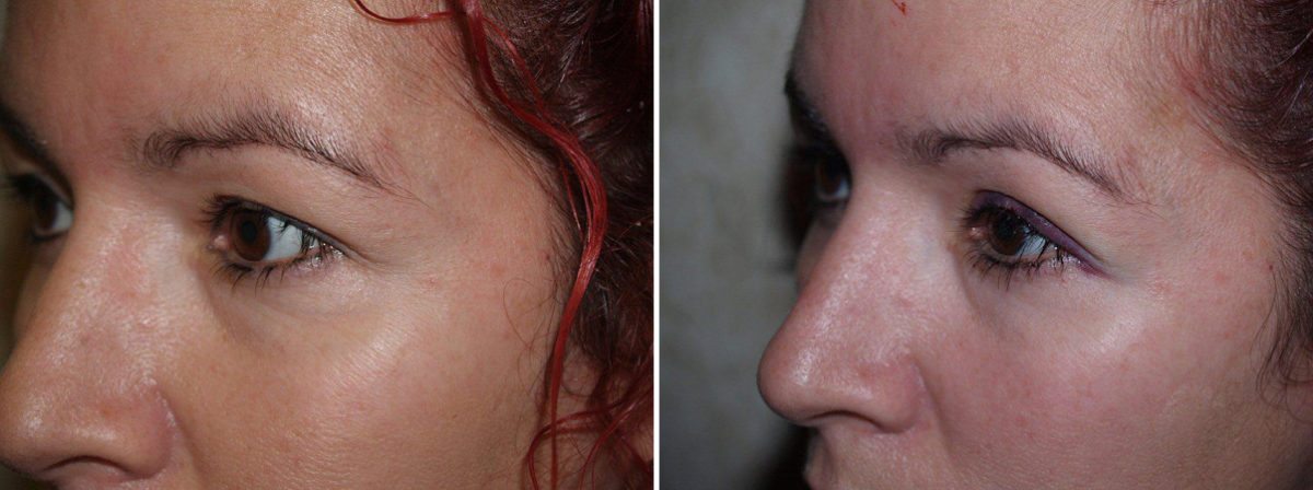 Eyebrow Transplantation before and after photos in Miami, FL, Patient 16375