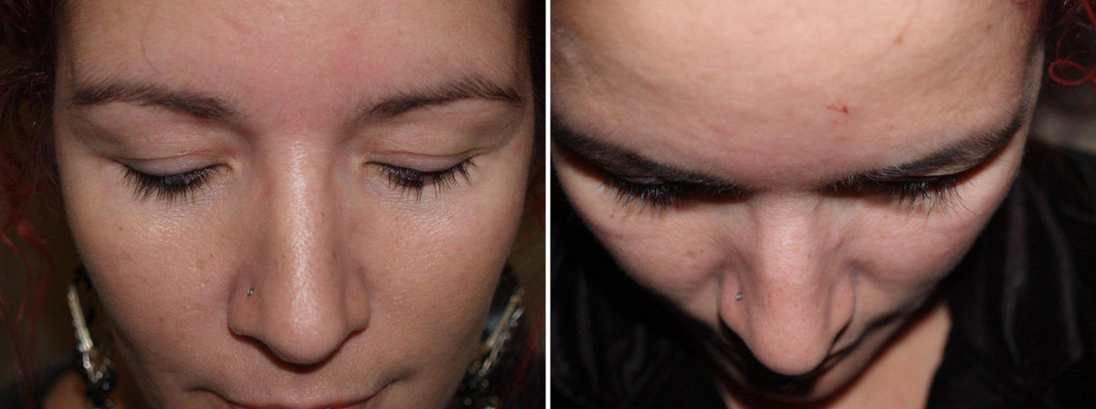 Eyebrow Transplantation before and after photos in Miami, FL, Patient 16375