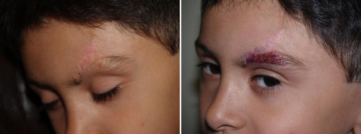 Eyebrow Transplantation before and after photos in Miami, FL, Patient 16387