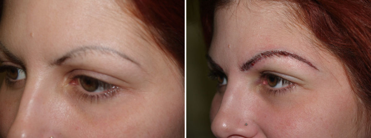 Eyebrow Transplantation before and after photos in Miami, FL, Patient 16416