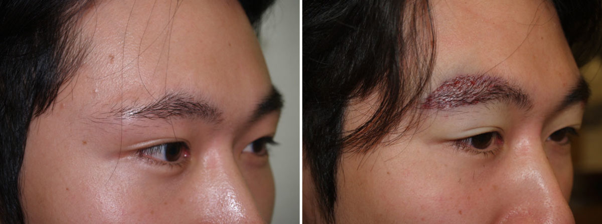 Eyebrow Transplantation before and after photos in Miami, FL, Patient 16423